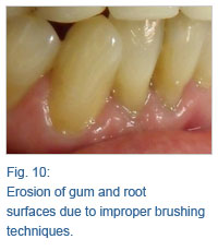 Gum Erosion